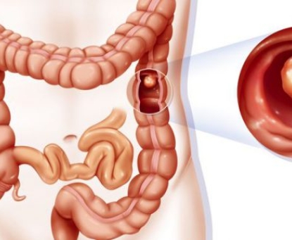 Tổng quan về ung thư trực tràng